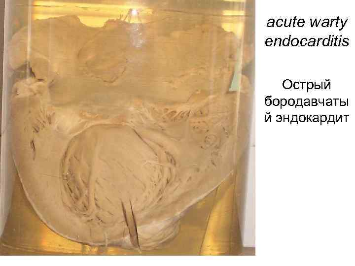 acute warty endocarditis Острый бородавчаты й эндокардит 