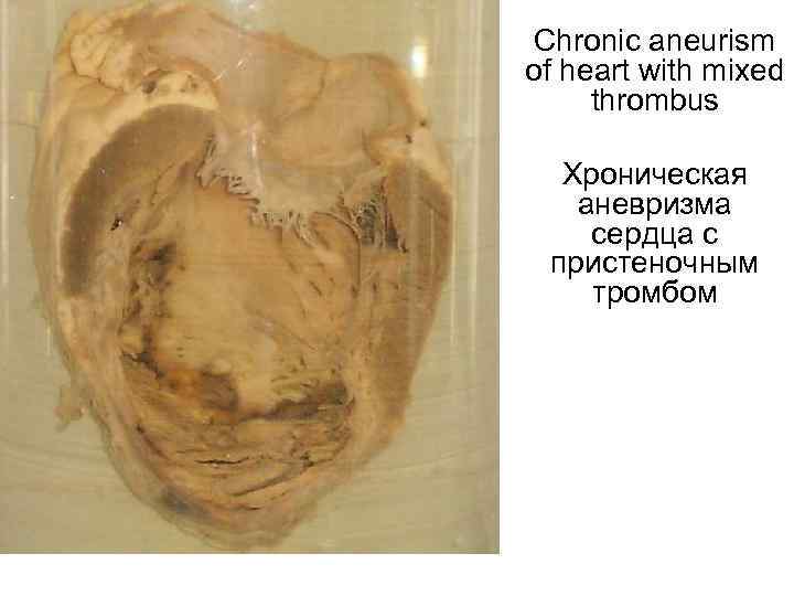 Chronic aneurism of heart with mixed thrombus Хроническая аневризма сердца с пристеночным тромбом 