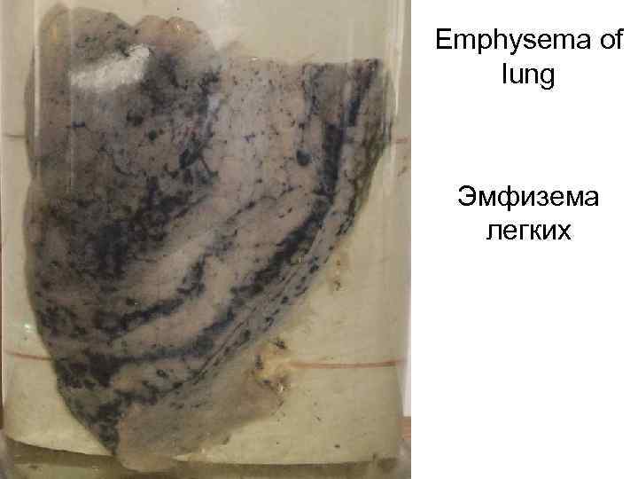 Emphysema of lung Эмфизема легких 