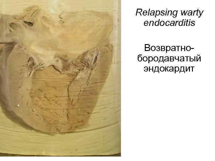 Relapsing warty endocarditis Возвратнобородавчатый эндокардит 