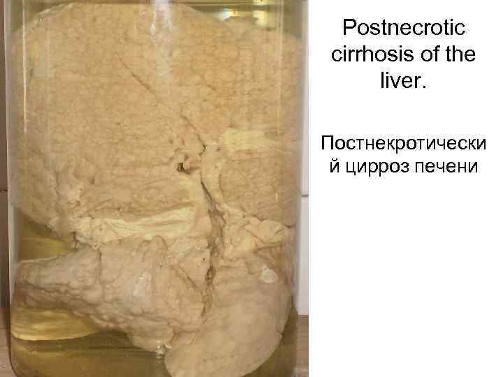 Postnecrotic cirrhosis of the liver. Постнекротически й цирроз печени 