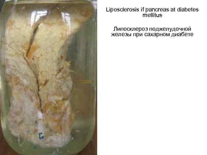 Liposclerosis if pancreas at diabetes mellitus Липосклероз поджелудочной железы при сахарном диабете 