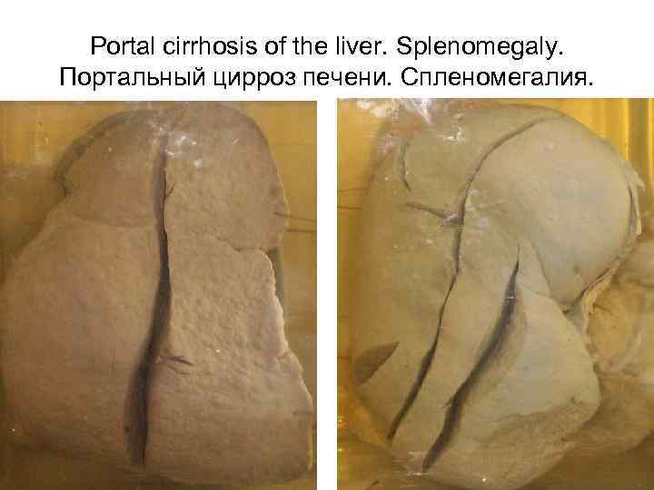 Portal cirrhosis of the liver. Splenomegaly. Портальный цирроз печени. Спленомегалия. 