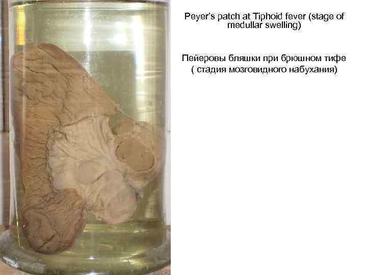 Peyer’s patch at Tiphoid fever (stage of medullar swelling) Пейеровы бляшки при брюшном тифе