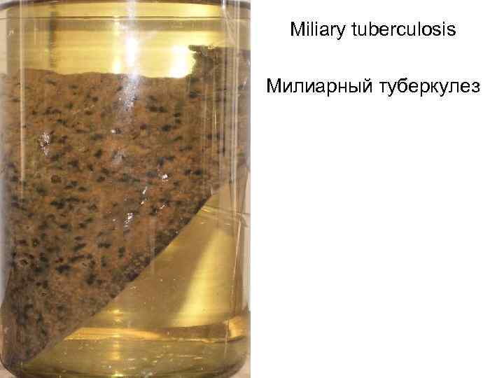Miliary tuberculosis Милиарный туберкулез 