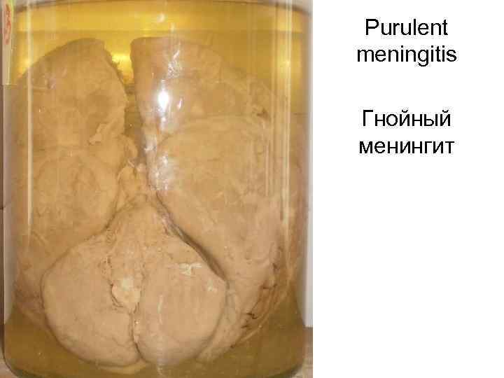 Purulent meningitis Гнойный менингит 