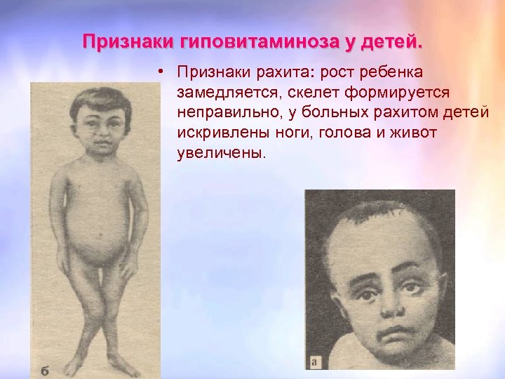Признаки гиповитаминоза у детей. • Признаки рахита: рост ребенка замедляется, скелет формируется неправильно, у