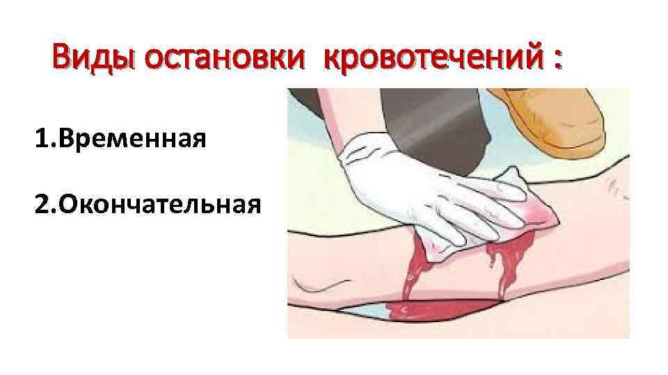 Виды остановки кровотечений : 1. Временная 2. Окончательная 