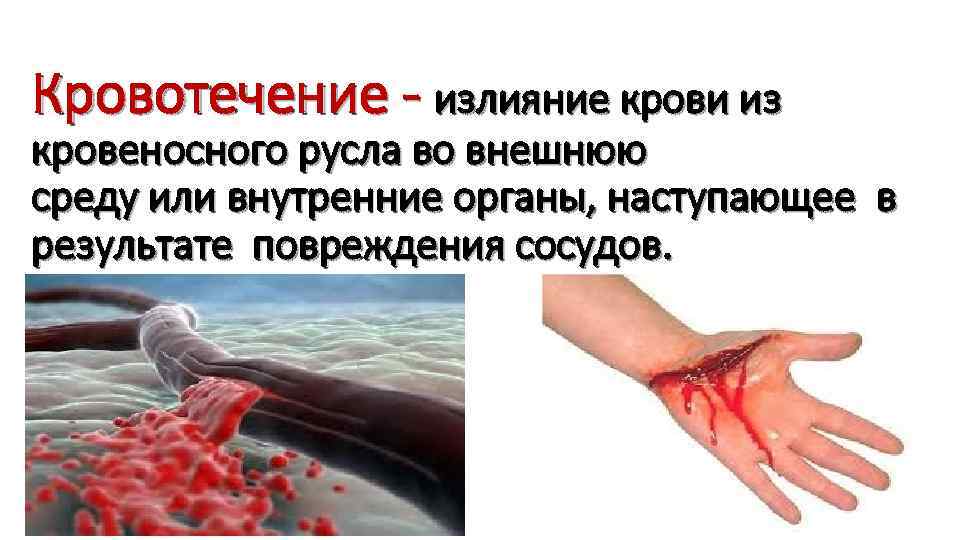 Кровотечение - излияние крови из кровеносного русла во внешнюю среду или внутренние органы, наступающее