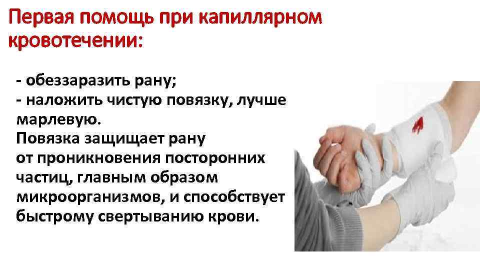 Первая помощь при капиллярном кровотечении: - обеззаразить рану; - наложить чистую повязку, лучше марлевую.