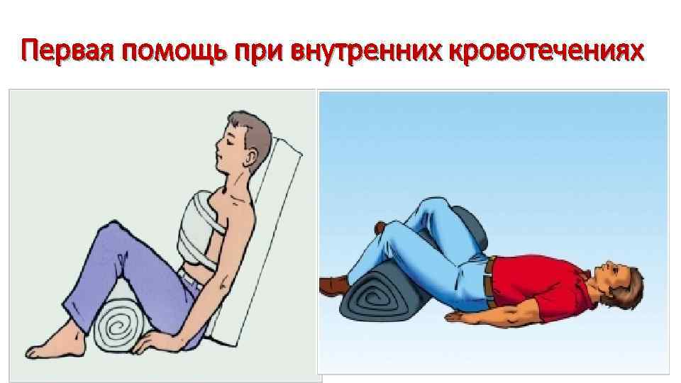 Первая помощь при внутренних кровотечениях 