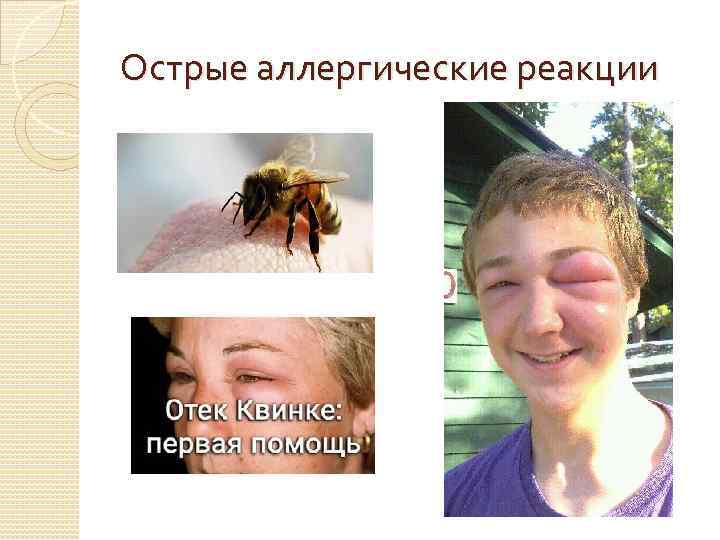 Острые аллергические реакции 