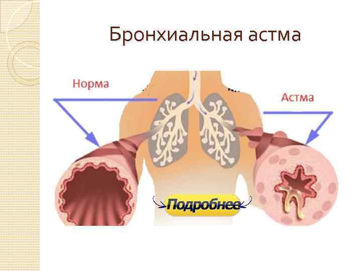 Бронхиальная астма 