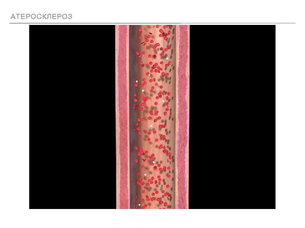 АТЕРОСКЛЕРОЗ 