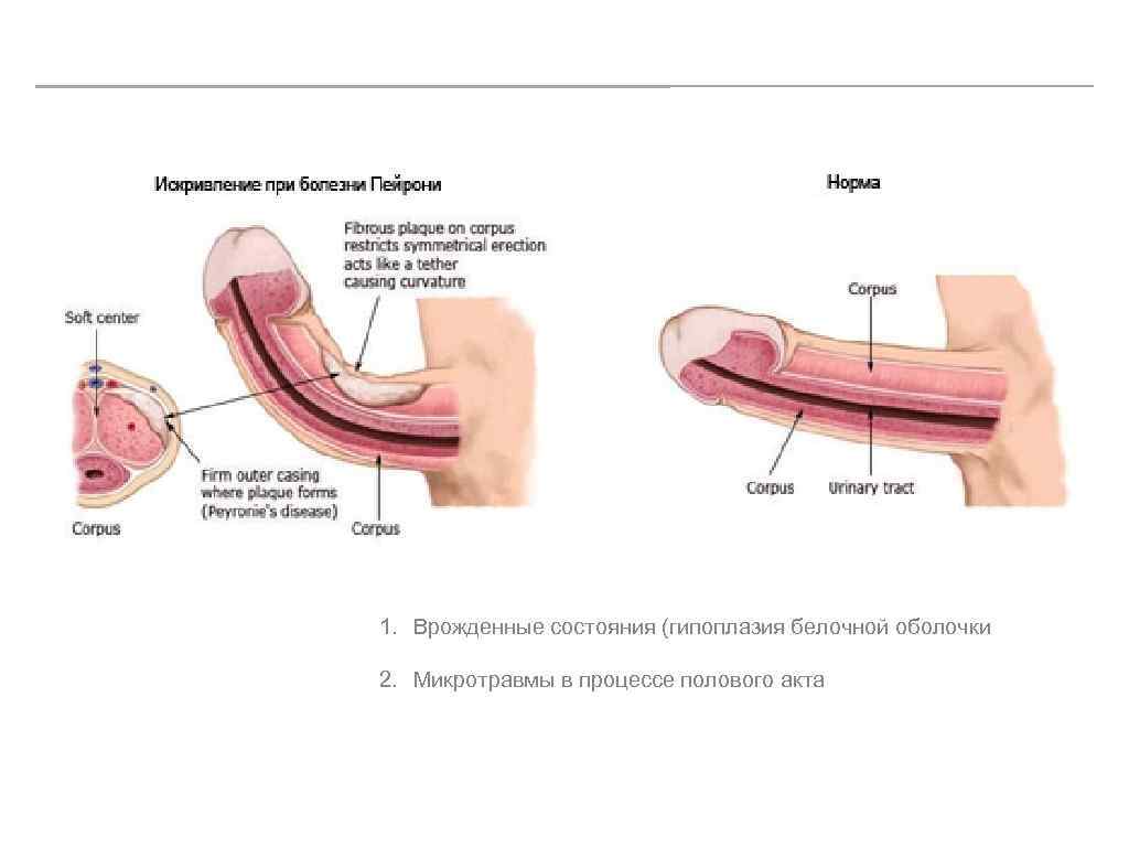 1. Врожденные состояния (гипоплазия белочной оболочки 2. Микротравмы в процессе полового акта 