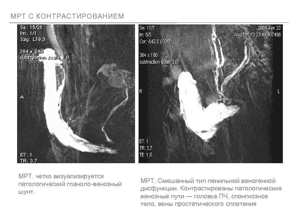 МРТ С КОНТРАСТИРОВАНИЕМ МРТ. четко визуализируется патологический гланоло-венозный шунт. МРТ. Смешанный тип пенильной веногенной