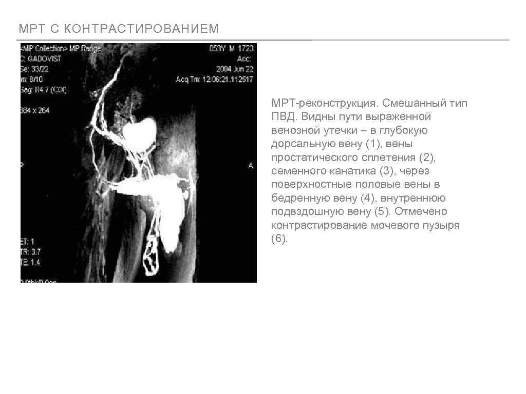 МРТ С КОНТРАСТИРОВАНИЕМ МРТ-реконструкция. Смешанный тип ПВД. Видны пути выраженной венозной утечки – в