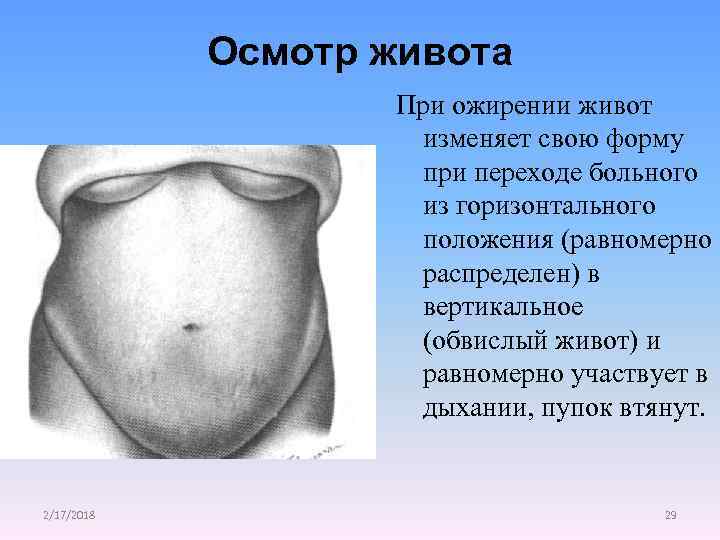 Осмотр живота При ожирении живот изменяет свою форму при переходе больного из горизонтального положения