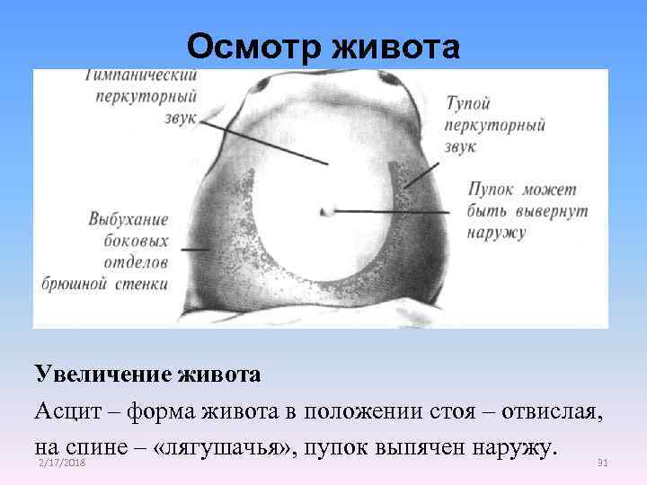 Осмотр живота Увеличение живота Асцит – форма живота в положении стоя – отвислая, на