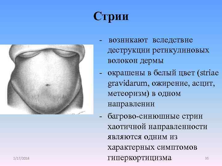 Стрии 2/17/2018 - возникают вследствие деструкции ретикулиновых волокон дермы - окрашены в белый цвет