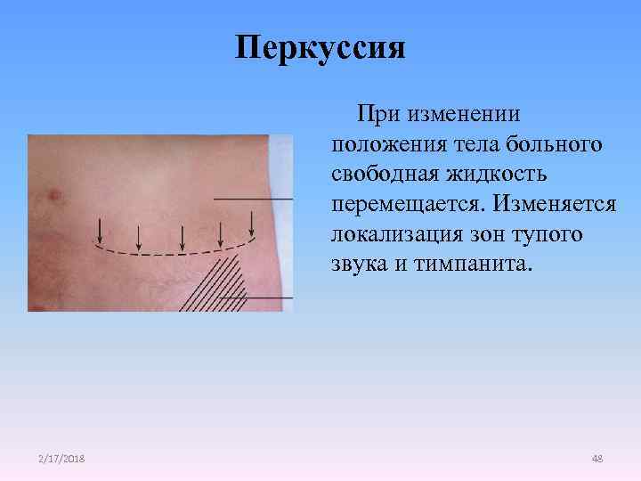 Перкуссия При изменении положения тела больного свободная жидкость перемещается. Изменяется локализация зон тупого звука