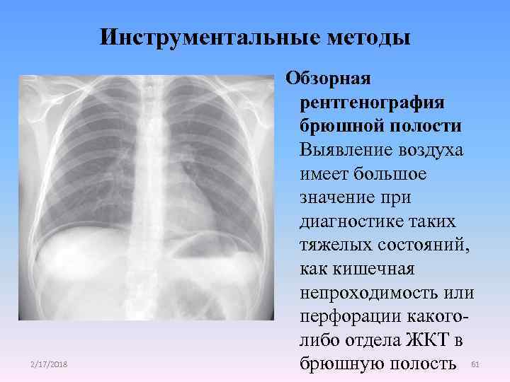 Инструментальные методы 2/17/2018 Обзорная рентгенография брюшной полости Выявление воздуха имеет большое значение при диагностике