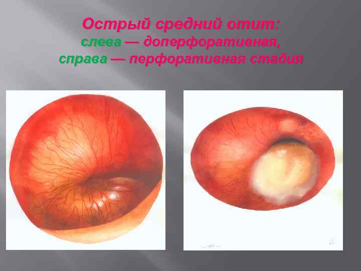 Острый средний отит: слева — доперфоративная, справа — перфоративная стадия 