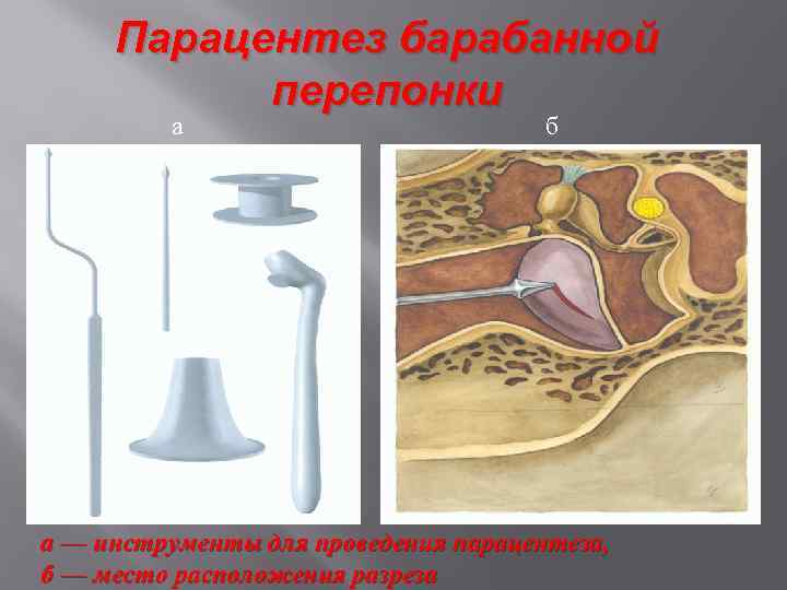 Парацентез барабанной перепонки а б а — инструменты для проведения парацентеза, б — место