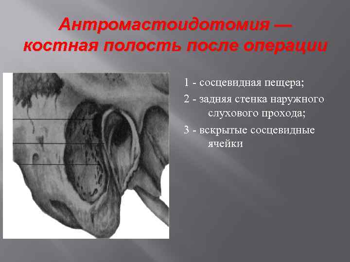 Антромастоидотомия — костная полость после операции 1 - сосцевидная пещера; 2 - задняя стенка