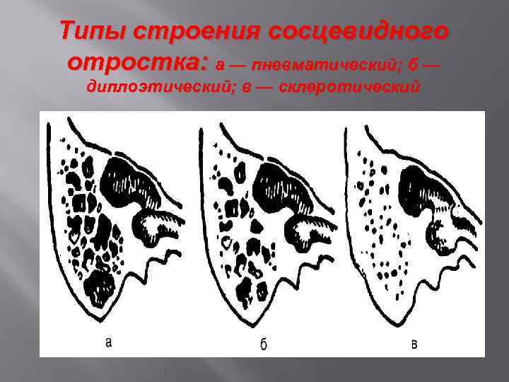 Типы строения сосцевидного отростка: а — пневматический; б — диплоэтический; в — склеротический 