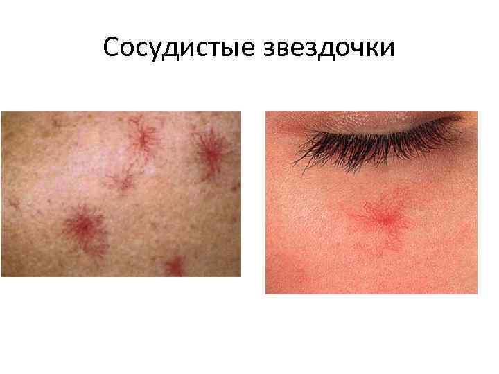 Сосудистые звездочки 