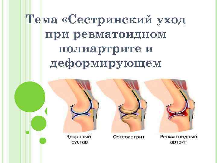 Тема «Сестринский уход при ревматоидном полиартрите и деформирующем остеоартрозе» 