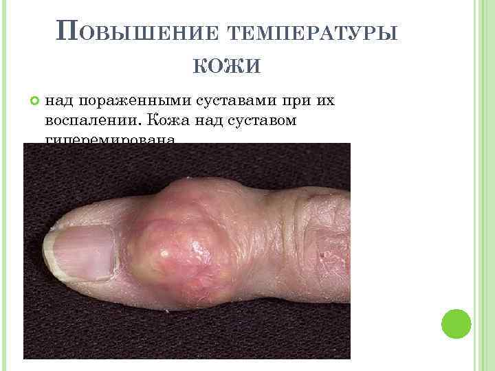 ПОВЫШЕНИЕ ТЕМПЕРАТУРЫ КОЖИ над пораженными суставами при их воспалении. Кожа над суставом гиперемирована 