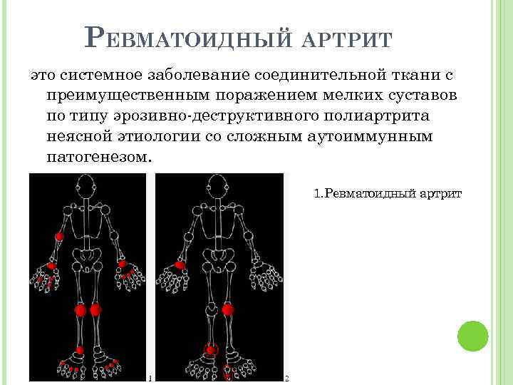 РЕВМАТОИДНЫЙ АРТРИТ это системное заболевание соединительной ткани с преимущественным поражением мелких суставов по типу