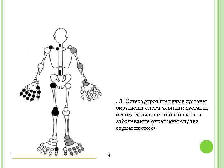 . 3. Остеоартроз (целевые суставы окрашены слева черным; суставы, относительно не вовлекаемые в заболевание