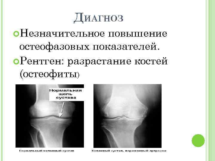 ДИАГНОЗ Незначительное повышение остеофазовых показателей. Рентген: разрастание костей (остеофиты). 