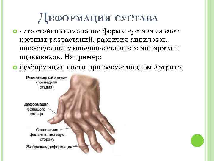 ДЕФОРМАЦИЯ СУСТАВА это стойкое изменение формы сустава за счёт костных разрастаний, развития анкилозов, повреждения