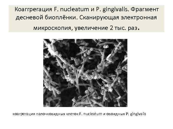 Коаггрегация F. nucleatum и P. gingivalis. Фрагмент десневой биоплёнки. Сканирующая электронная микроскопия, увеличение 2