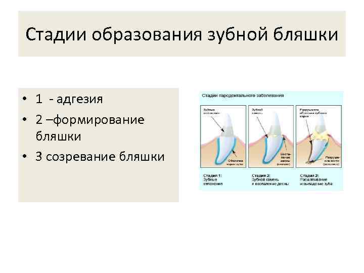 Стадии образования зубной бляшки • 1 - адгезия • 2 –формирование бляшки • 3