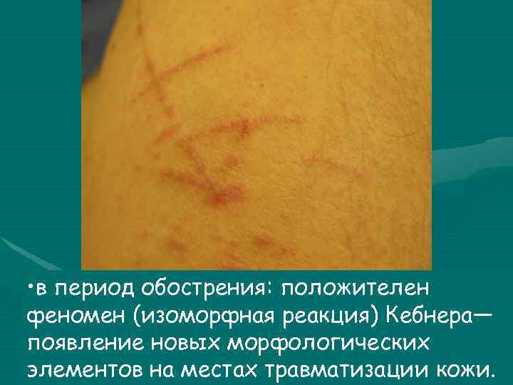  • в период обострения: положителен феномен (изоморфная реакция) Кебнера— появление новых морфологических элементов