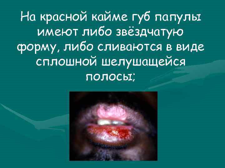 На красной кайме губ папулы имеют либо звёздчатую форму, либо сливаются в виде сплошной