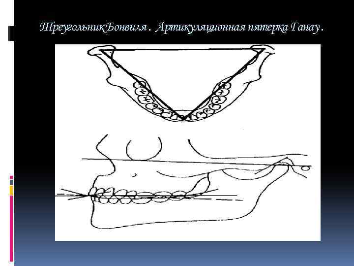 Треугольник Бонвиля. Кламмер Бонвиля. Артикуляционная пятерка Ганау.