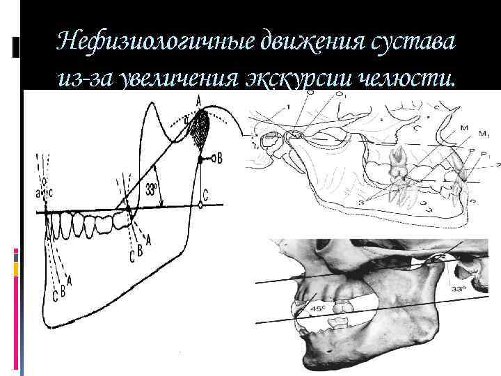 Нефизиологичные движения сустава из-за увеличения экскурсии челюсти. 