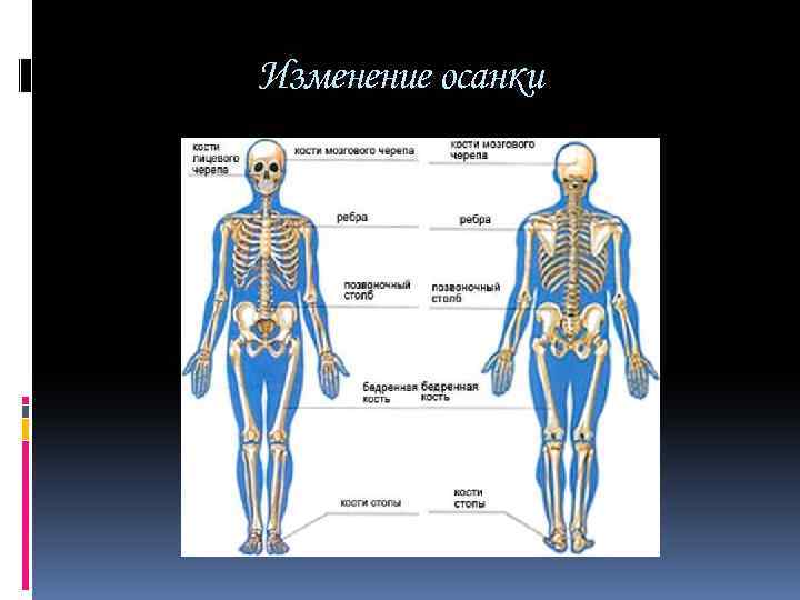 Изменение осанки 