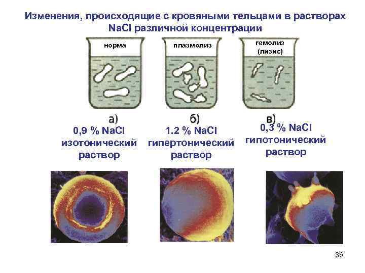 Изменения, происходящие с кровяными тельцами в растворах Na. Cl различной концентрации норма плазмолиз гемолиз