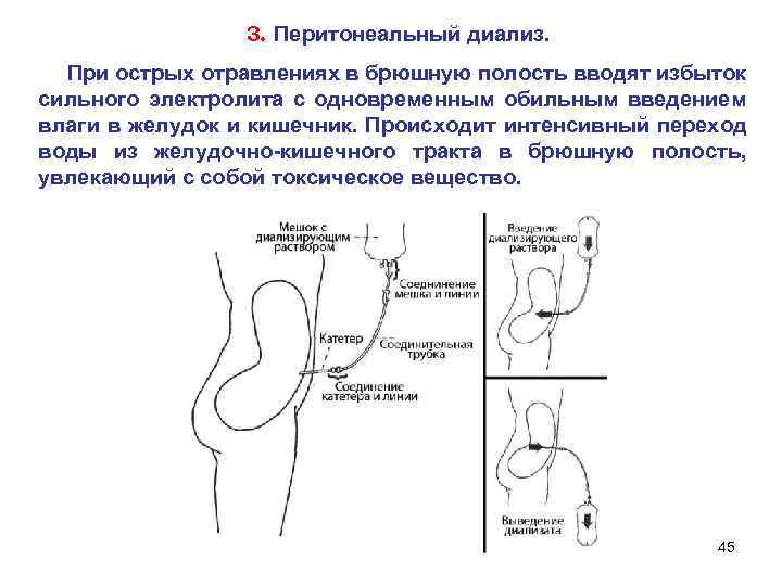 3. Перитонеальный диализ. При острых отравлениях в брюшную полость вводят избыток сильного электролита с