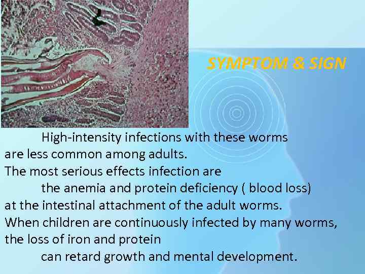 SYMPTOM & SIGN High-intensity infections with these worms are less common among adults. The