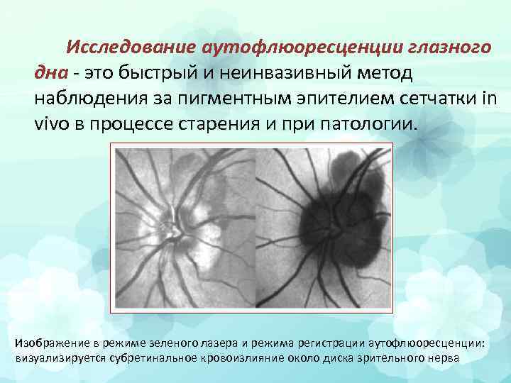 Исследование аутофлюоресценции глазного дна - это быстрый и неинвазивный метод наблюдения за пигментным эпителием
