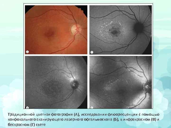 Традиционной цветная фотография (A), исследовании флюоресценции с помощью конфокального сканирующего лазерного офтальмоскопа (Б), в