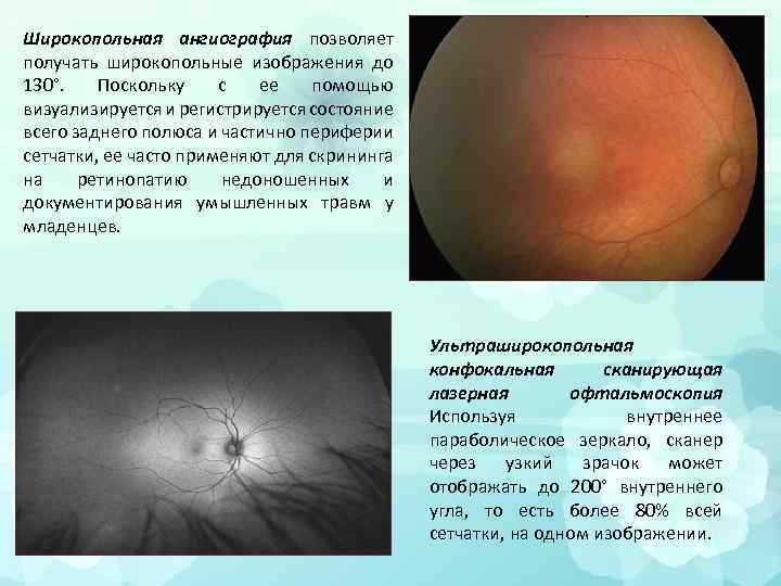 Широкопольная ангиография позволяет получать широкопольные изображения до 130°. Поскольку с ее помощью визуализируется и
